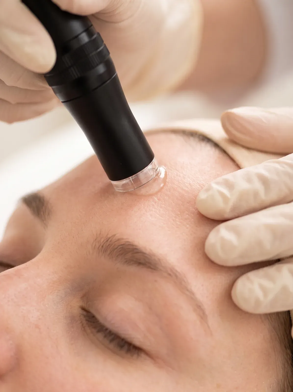 Micro-Needling-Gerät gleitet über die Stirn, die Behandlerin spannt die Haut mit zwei Fingern